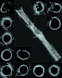 Development, image interpretation, clinical experience, and applications  of optical coherence tomography in neurointerventional surgery